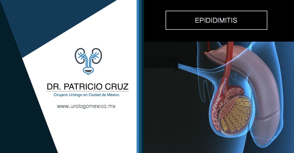 Epididimitis Dr Patricio Cruz Cirujano Urólogo México