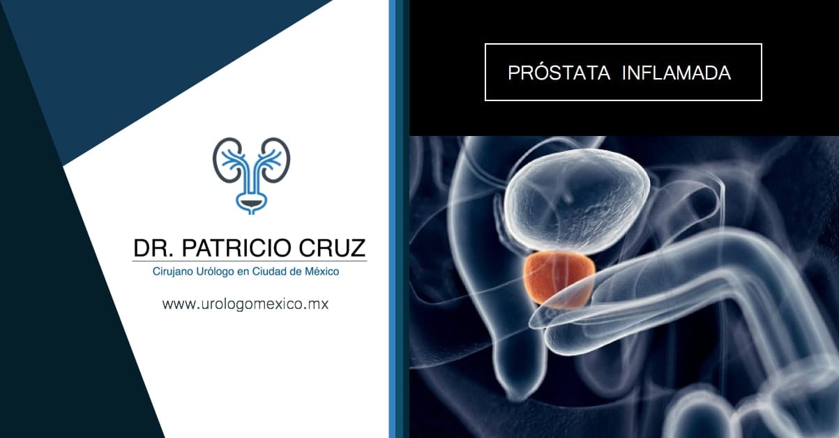 S Ntomas De Pr Stata Inflamada Dr Patricio Cruz Ur Logo En M Xico